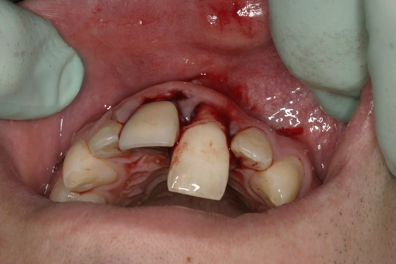 dental trauma